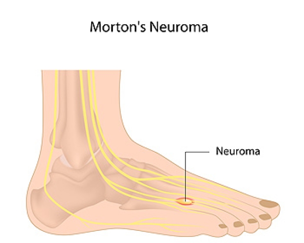 Why the Ball of Your Foot Feels Like It Is on Fire